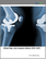 Global Digit Joint Implants Market 2025-2029